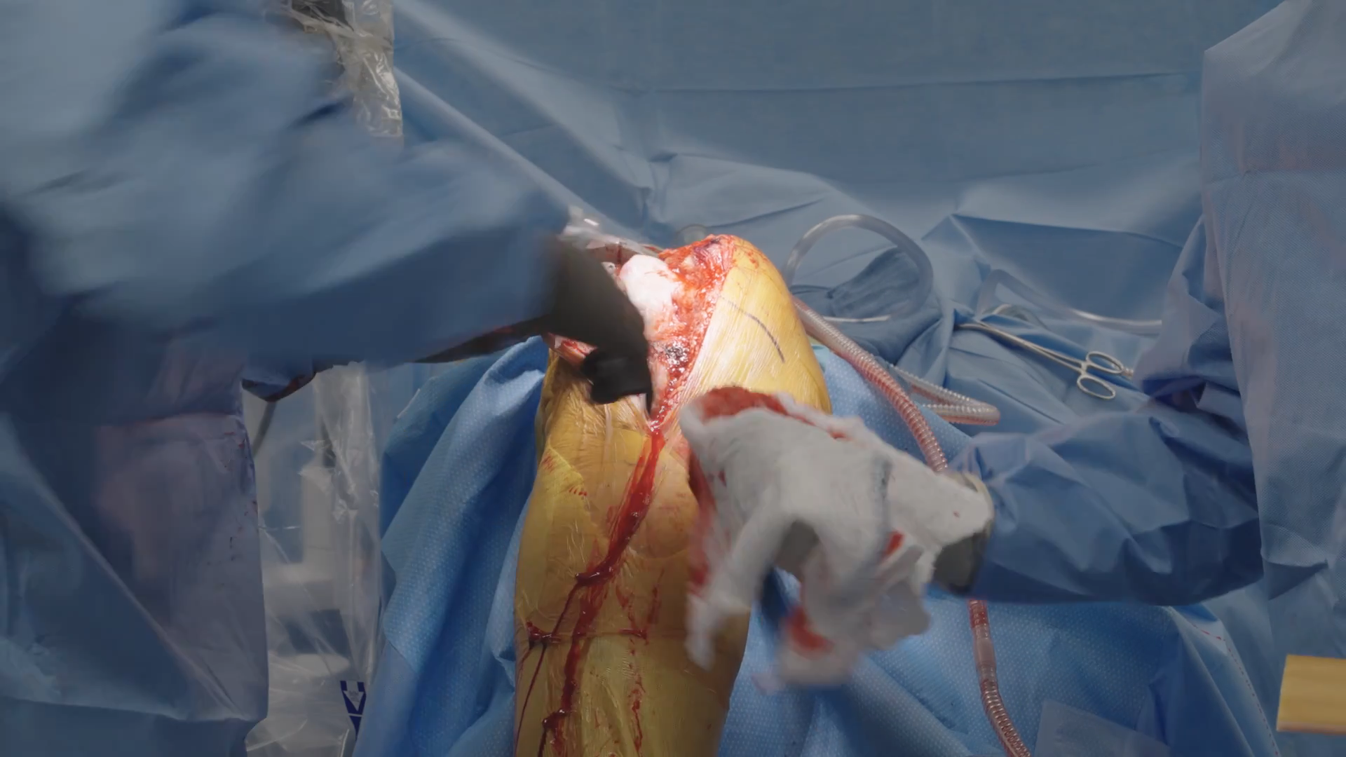 Primary Total Knee Using The Velys Robotic Assisted Solution Live