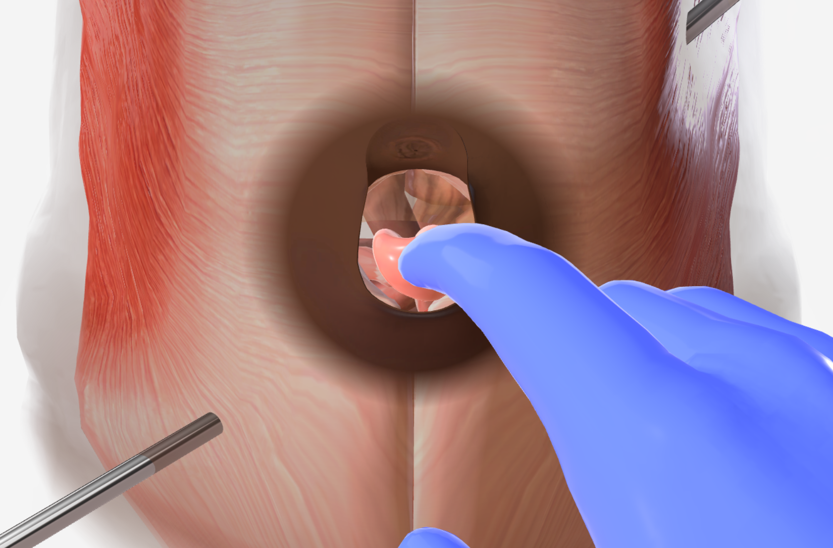 Ventral Hernia Repair - Medium Hernia with Mesh