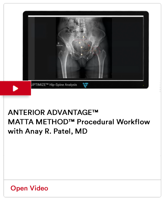 Anterior Advantage Matta Method Image