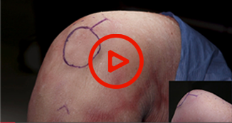 All-Inside ACL Recon