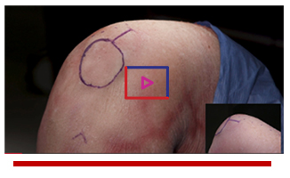 All-Inside ACL Reconstruction using Quad Tendon - Justin Ernat, MD Image