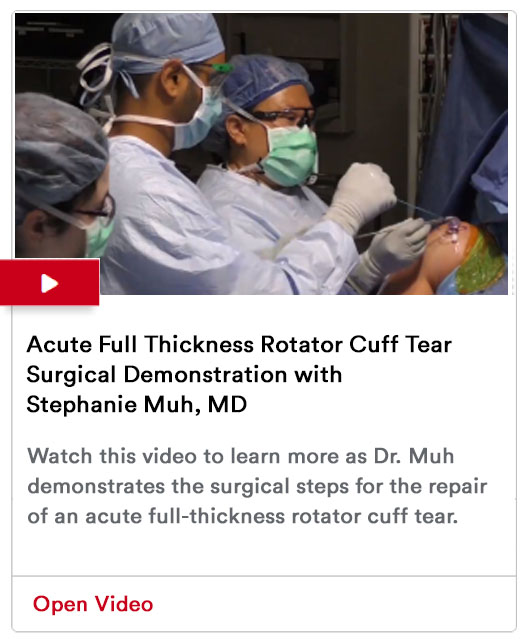 Acute Full Thickness Rotator Cuff Tear Surgical Demonstration with Stephanie Muh, MD Video Image