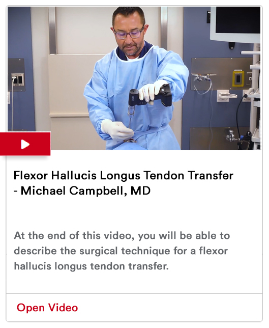 Flexor Hallucis Longus Tendon Transfer Image