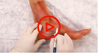 Flexor Hallucis Longus Tendon Transfer