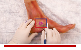 Flexor Hallucis Longus Tendon Transfer - Michael Campbell, MD Image