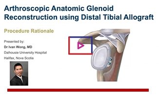 Arthroscopic Anatomic Glenoid Reconstruction using Distal Tibial Allograft: Procedure Rationale Image