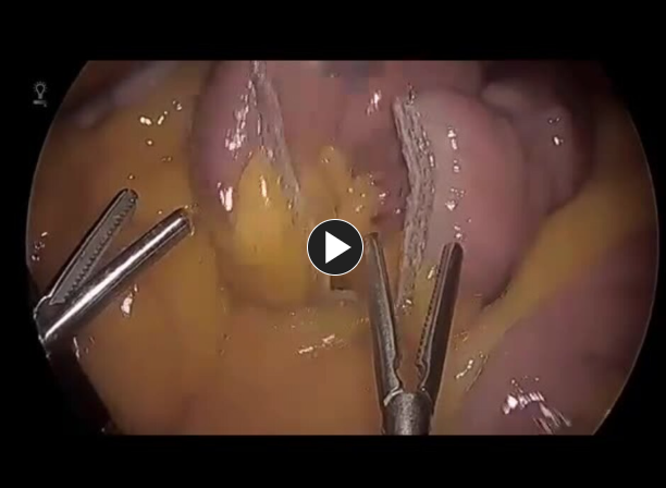 Link to Laparoscopic Roux-en-Y Gastric Bypass - Identify the Correct Limb
