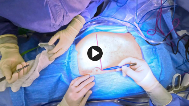Incision