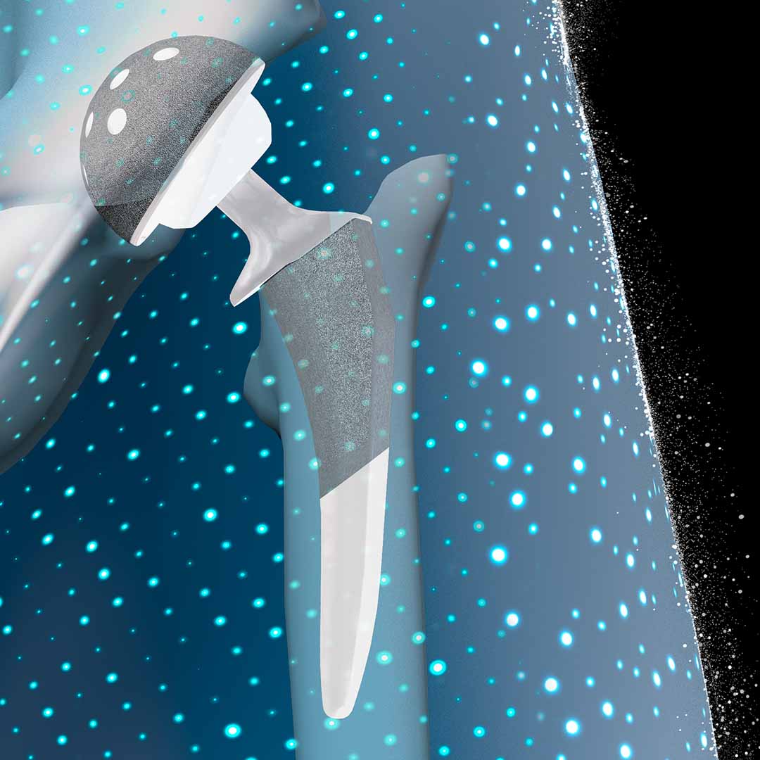 ACTIS Emphasys Implant Image