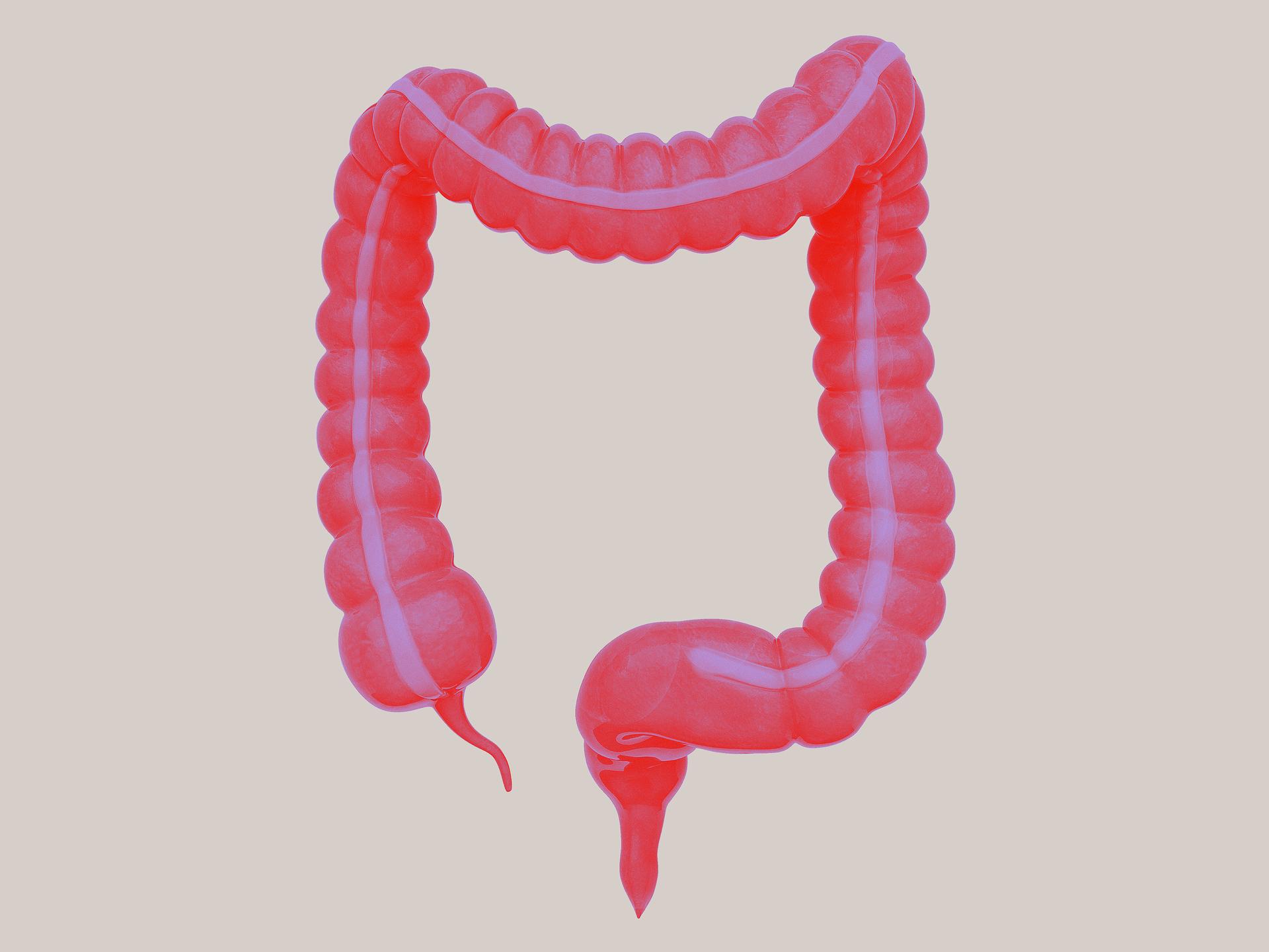 Laparascopic Appendectomy Image