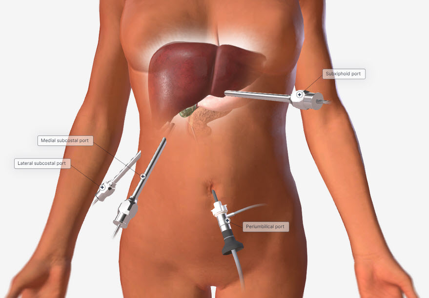 Lap Chole Port Placement Image