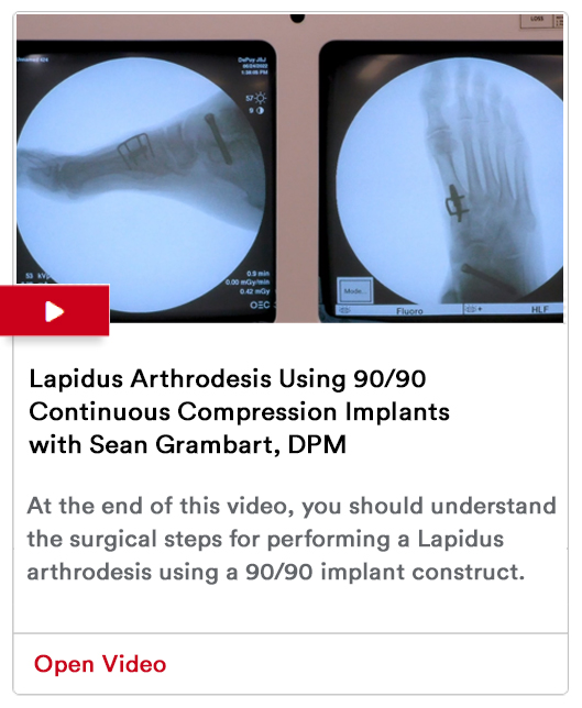 Lapidus Arthrodesis Using 90/90 Continuous Compression Implants Image