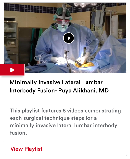 Minimally Invasive Lateral Lumbar Interbody Fusion Image