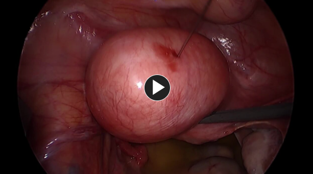 fibroid identification