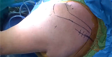 Arthroscopic Assisted Lower Trapezius Transfer