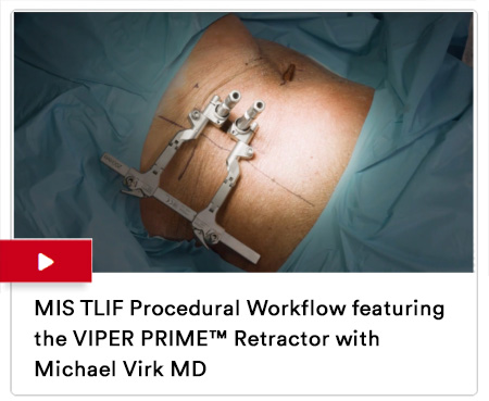 MIS TLIF Procedural Workflow featuring the VIPER PRIME™️ Retractor with Michael Virk MD Image