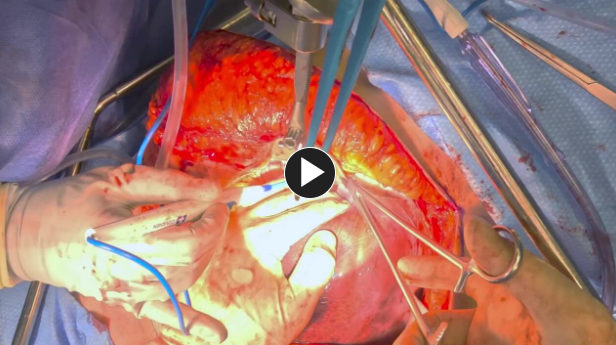Mobilize Liver