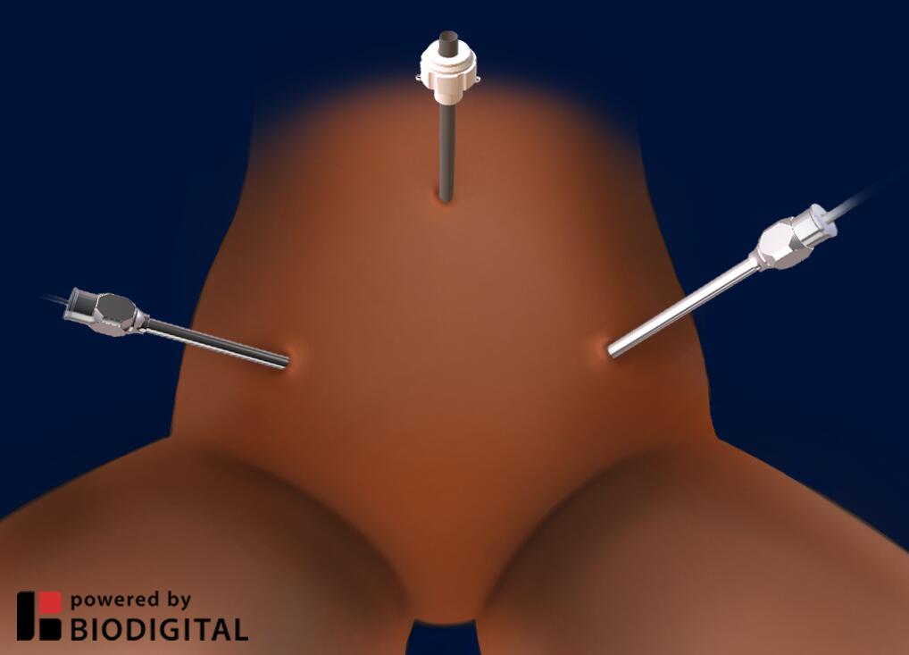 Common port placement