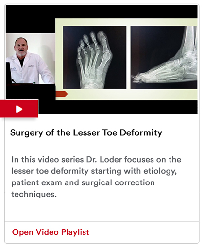 Surgery of the Lesser Toe Deformity Image