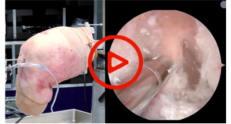 Posterior Cruciate Ligament Recon Image