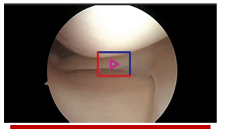 Posterolateral Corner Reconstruction using the Mitek Sports Medicine Knee Portolio with Dean Wang, MD Image