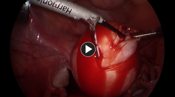 uterus grasper