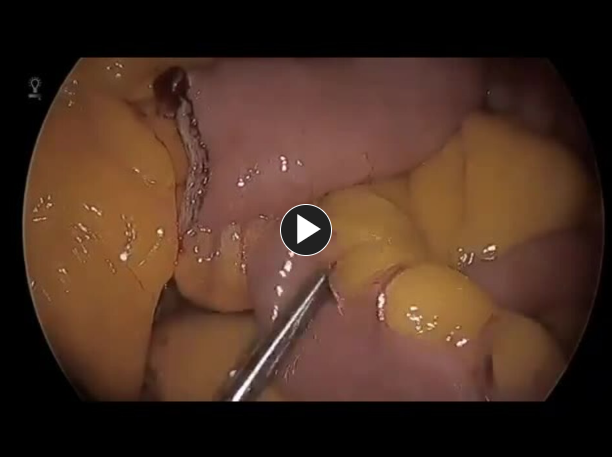 Linke to Laparoscopic Roux-en-Y Gastric Bypass - Create Enterotomies
