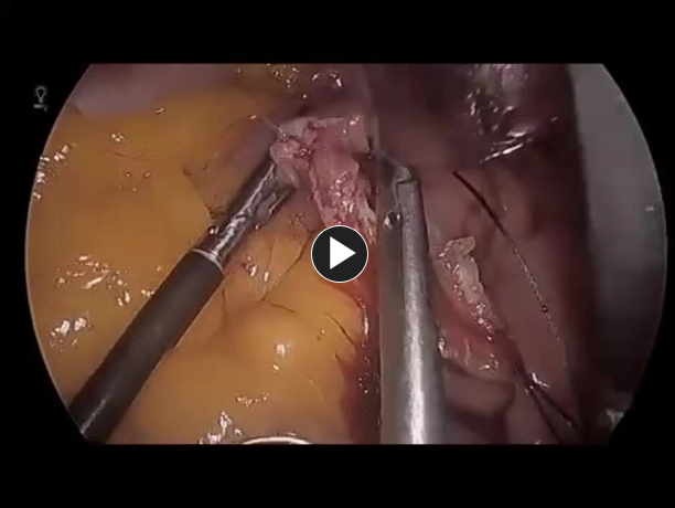Link to Laparoscopic Roux-en-Y Gastric Bypass - Enterotomy Closure