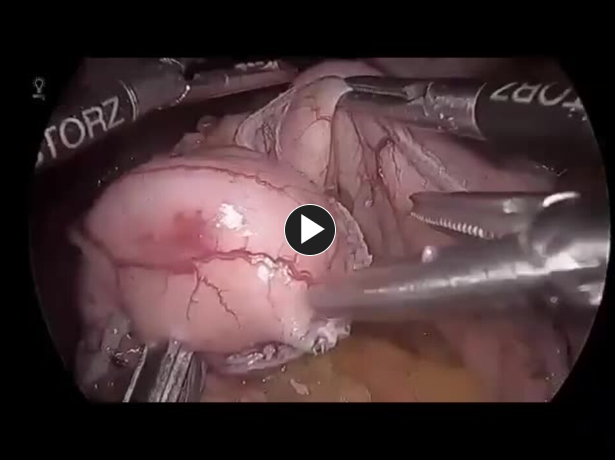 Link to Laparoscopic Roux-en-Y Gastric Bypass - Creation of Gastrojejunostomy
