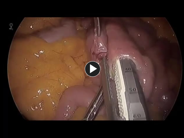 Link to Laparoscopic Roux-en-Y Gastric Bypass - Create Jejunojejunostomy