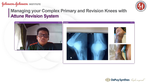 thumb managing your complex primary and revision knees