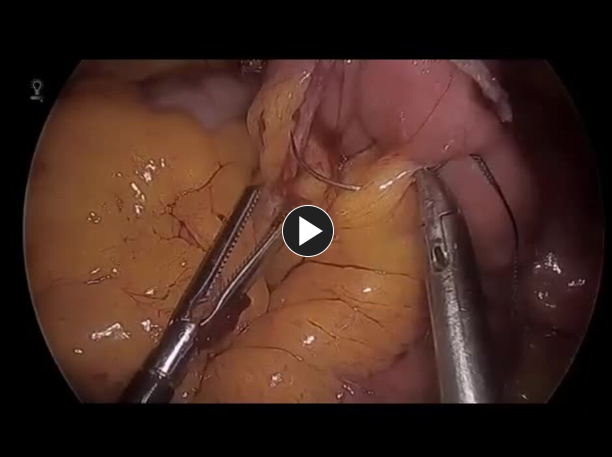 link to Laparoscopic Roux-en-Y Gastric Bypass - Closure of Mesenteric Defect