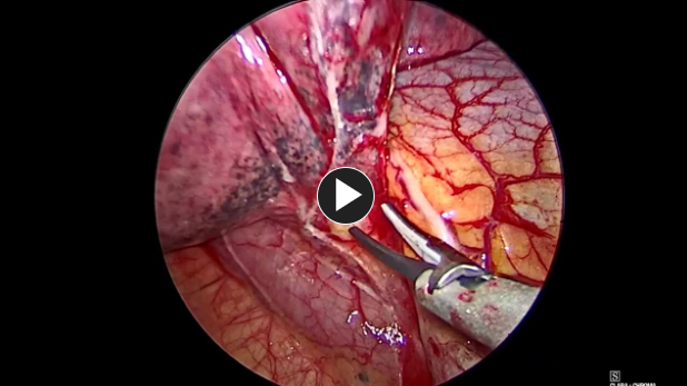 Mobilize Inferior Pulmonary Ligament