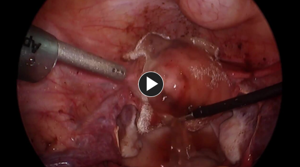 https://jnjinstitute.com/en-au/online-profed-resources/resources/laparoscopic-myomectomy-topical-hemostat-suture-closure-site