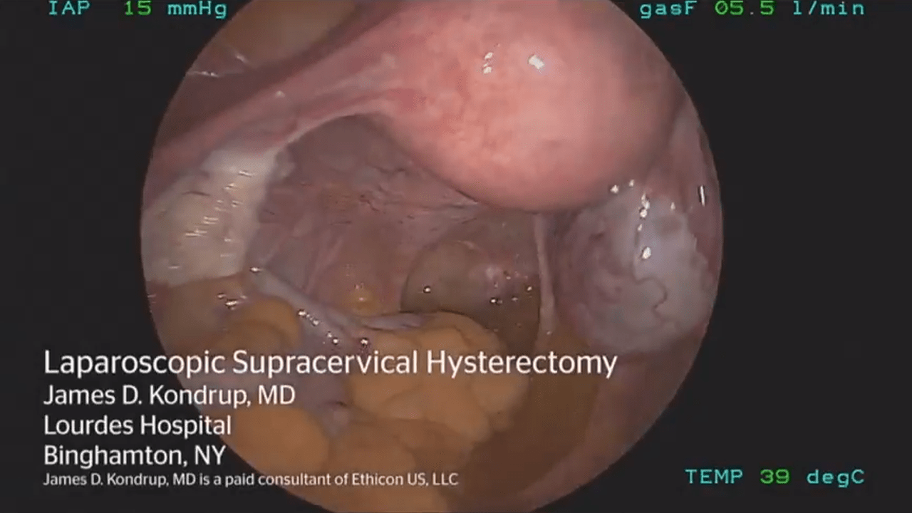 Laparoscopic Supracervical Hysterectomy using HARMONIC ACE+ with James ...