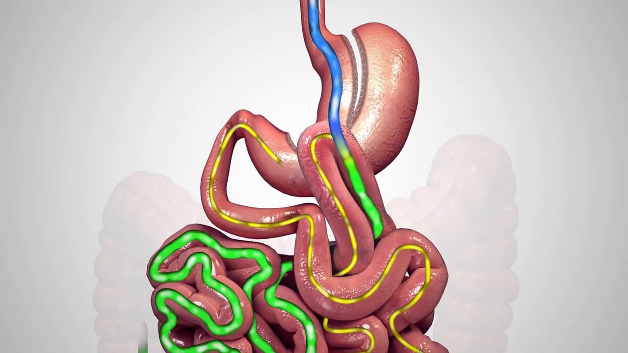 One Anastomosis Gastric Bypass Procedure Animation