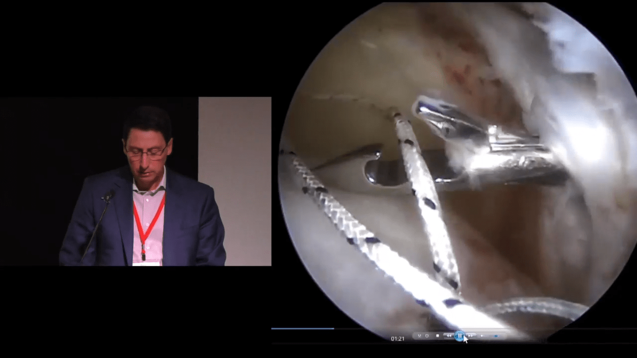 Superior Capsular Reconstruction Key Surgical Steps with Paul Favorito ...