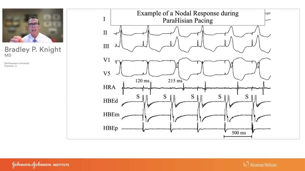 Step-by-Step Approach for Analyses of ECG and EGM Tracings to ...