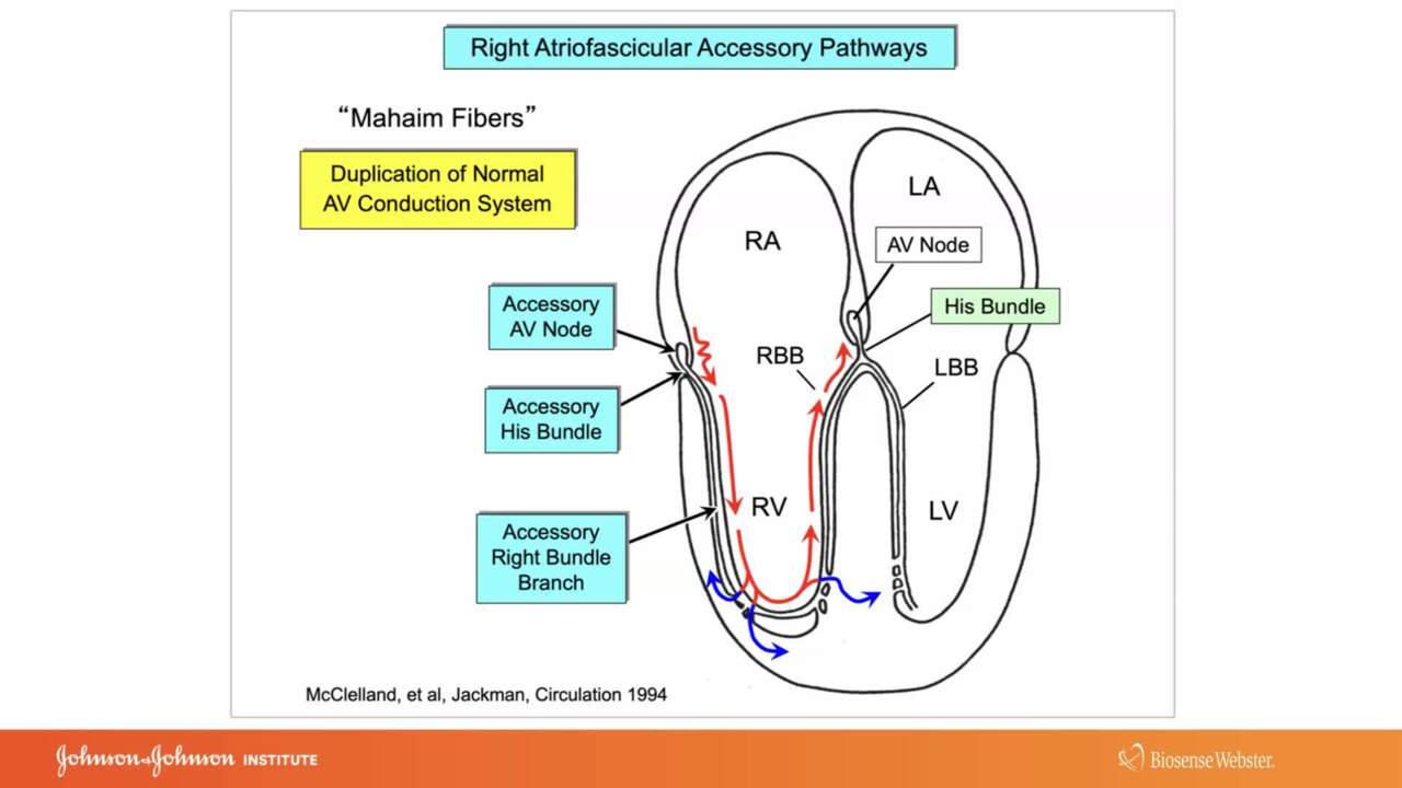 Use of ECG and Intracardiac Recordings to Diagnose and Demonstrate the ...