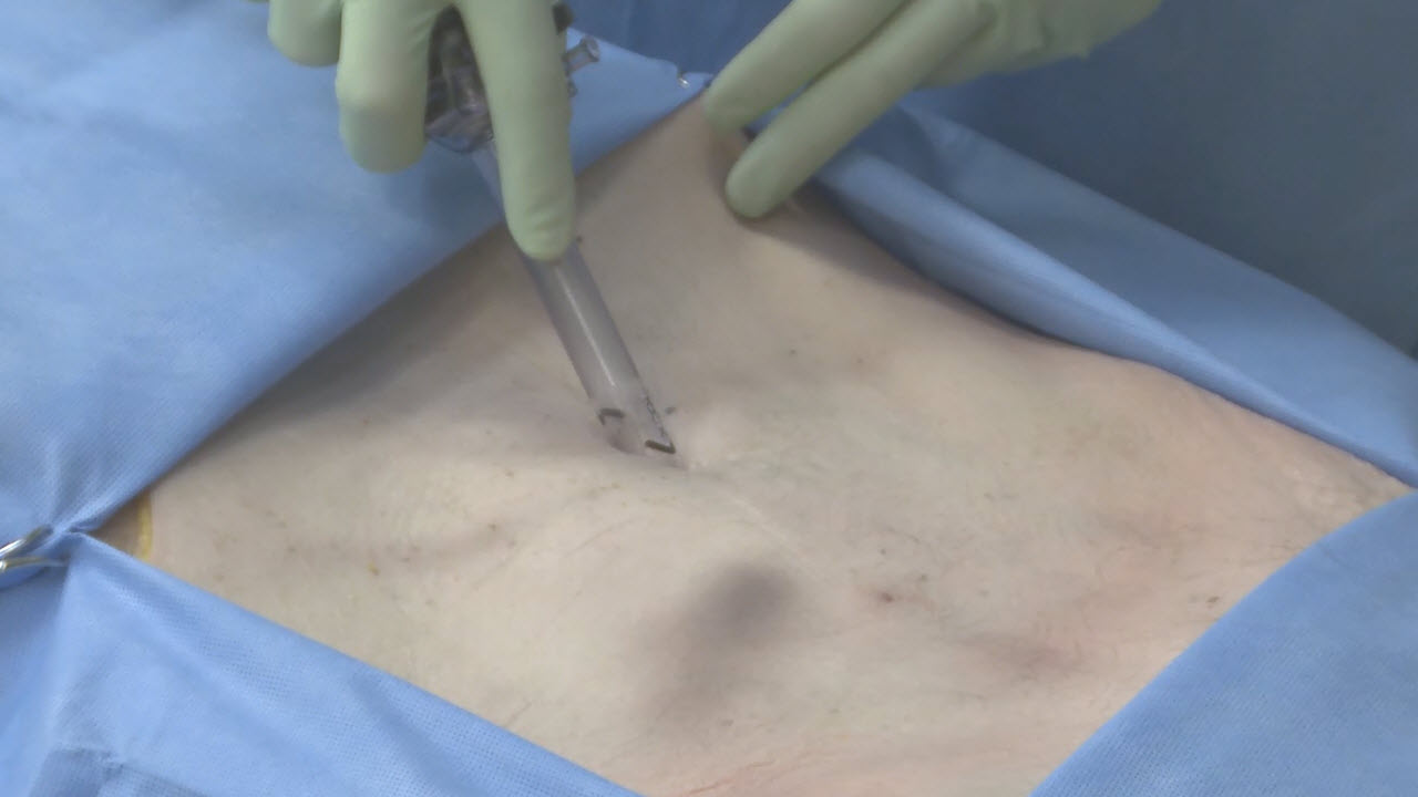 Laparoscopic Right Colectomy Step 1 Port Placement With David Longcope Md Johnson 2902
