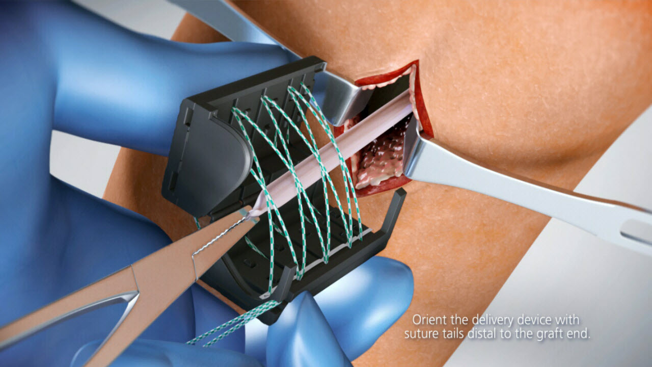 innovations-in-soft-tissue-acl-reconstruction-meniscal-repair