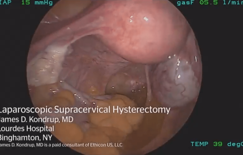 An image of the "Laparoscopic Supracervical Hysterectomy using HARMONIC ACE+ with James Kondrup, MD" video on the JnJInstitute.com website.