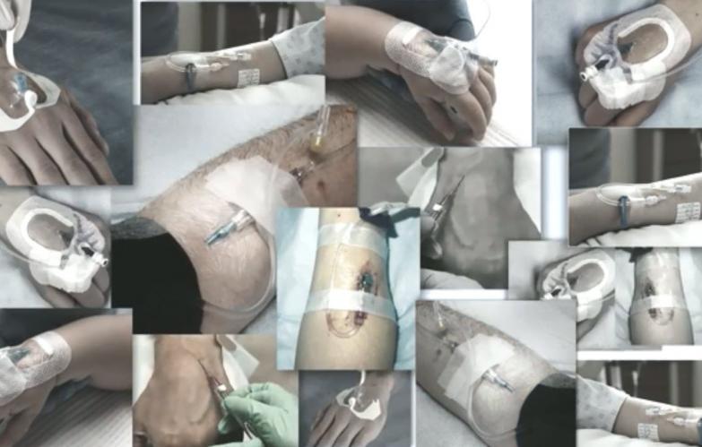 An image showing multiple peripheral IV catheters using BIOPATCH. 