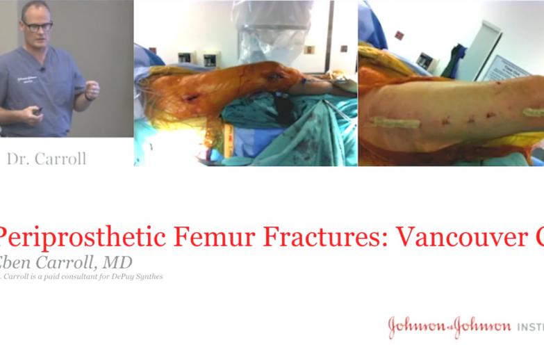 An image of the "Periprosthetic Femur Fractures: Vancouver C with Eben Carroll, MD" video.