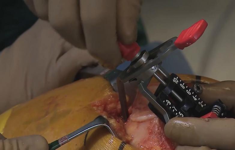 Image from the "Live ATTUNE® Knee System TKA Surgical Procedure with Dr. Robert Gorab" video.