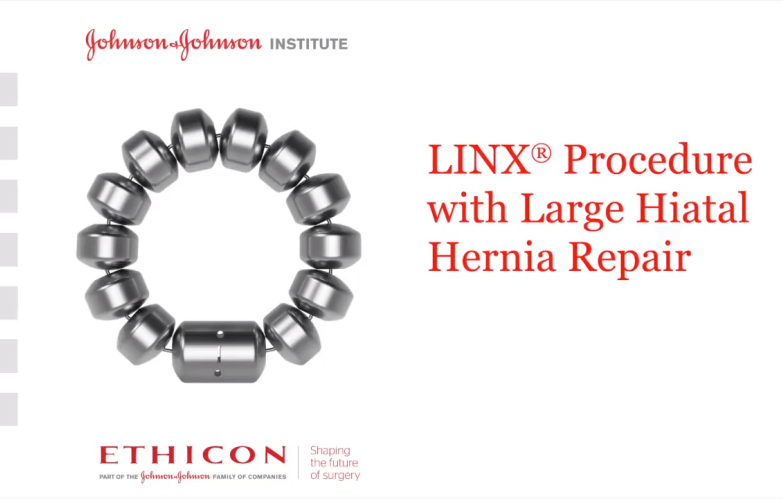 LINX Procedure Video – Large Hiatal Hernia with John Lipham, MD