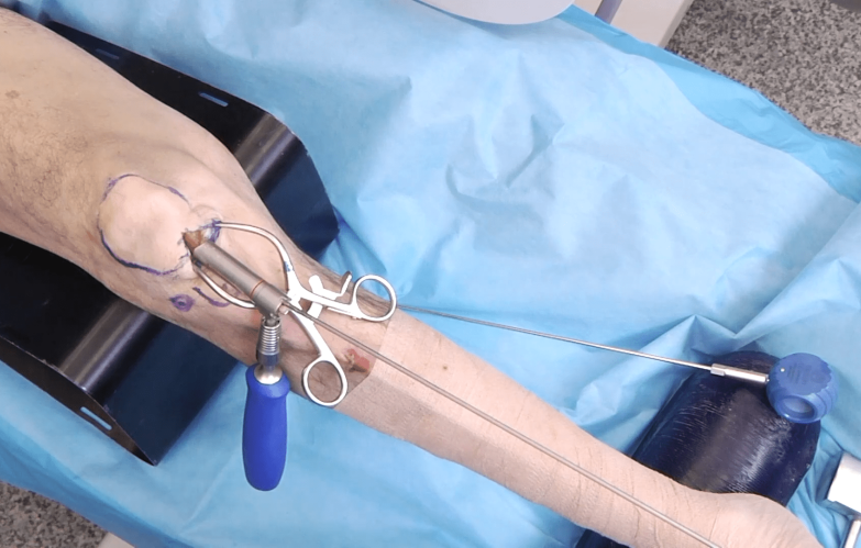 An image from the "RFN-Advanced Retrograde Femoral Nailing System (RFNA): Nail Insertion" video on the JnJInstitute.com website.