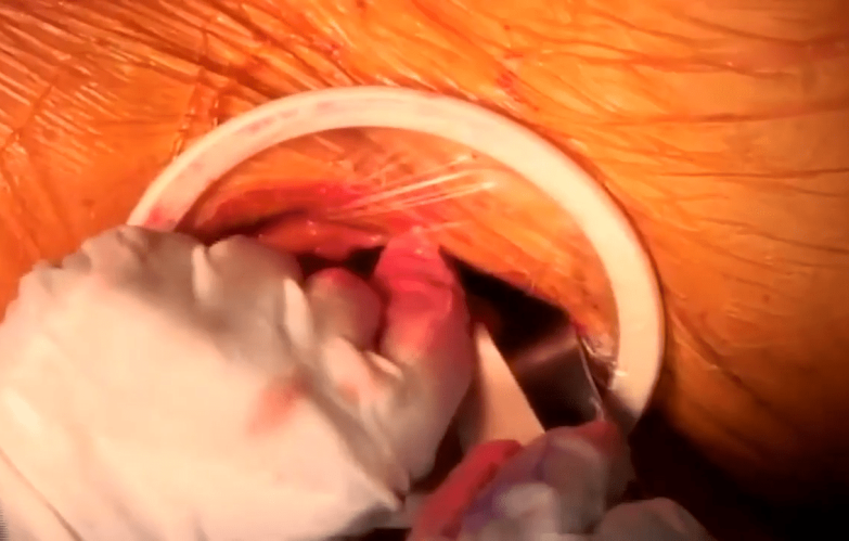 image of Anterior Approach: Capsular Exposure with Joel Matta, MD video on jnjinstitute.com