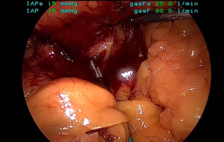 An Image from "Jean Ashburn, MD performing a Right Colectomy using the ECHELON 3000 Stapler and ENSEAL X1 Straight Jaw"