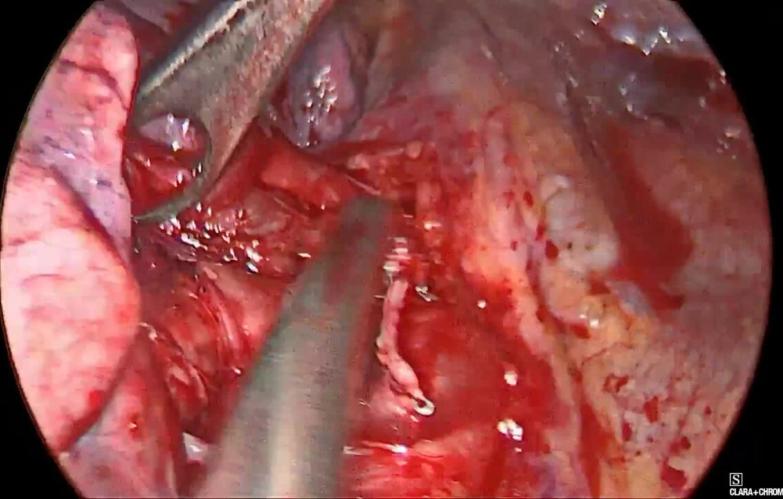 An Image From " VATS Wedge Resection and Lobectomy with ECHELON 3000 stapler, with John Roberts, MD"